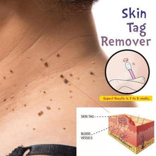 Load image into Gallery viewer, Skin Tag Remover Skin Care 1PC